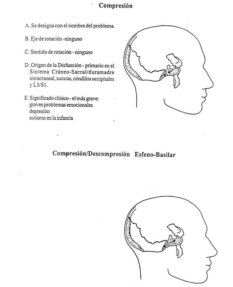 18-Comprension esfenobasilar