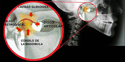 32-Mandibula-condilo