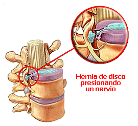 45-Hernia_disco